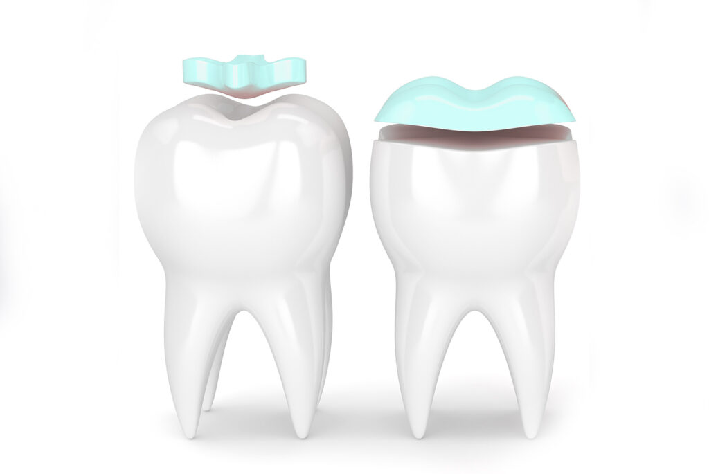Haltom City preventive dentistry